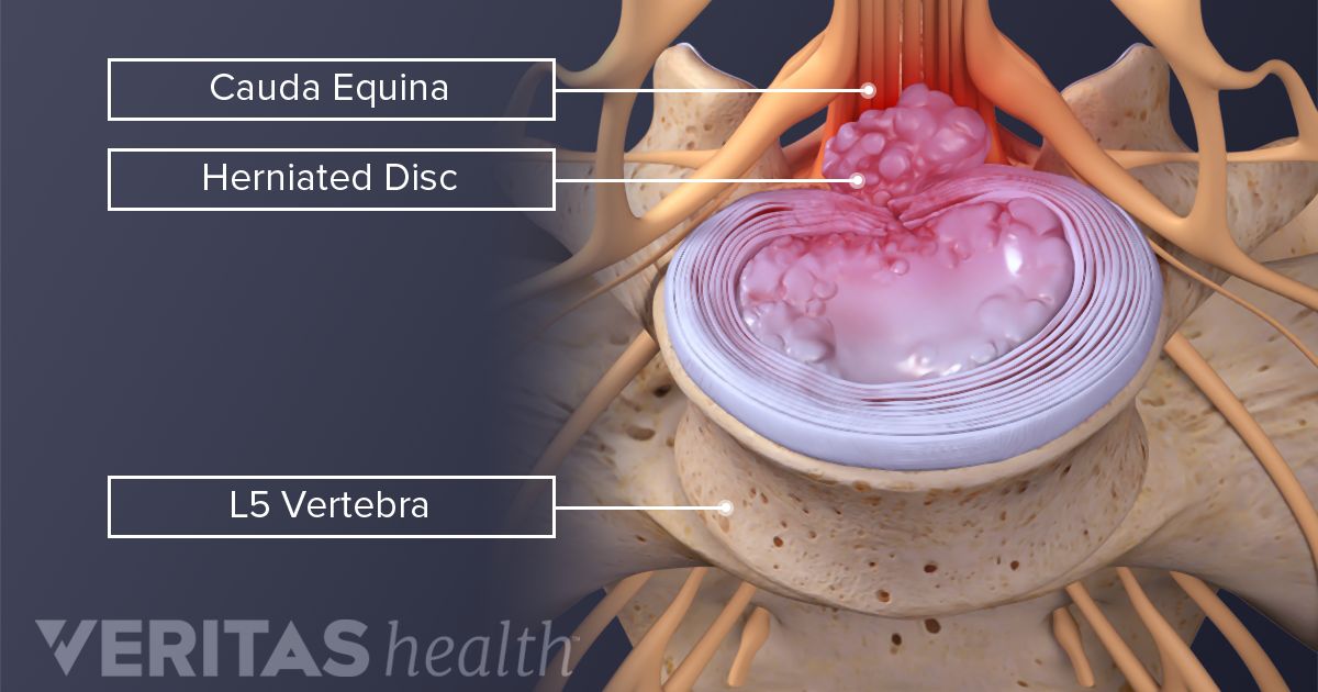 Inflamacion de la medula y la perdida de peso